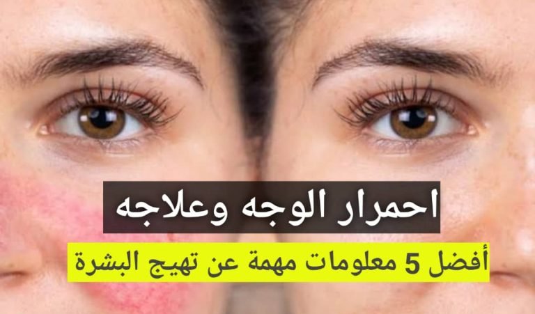 Read more about the article احمرار الوجه وعلاجه أفضل 5 معلومات مهمة عن تهيج البشرة