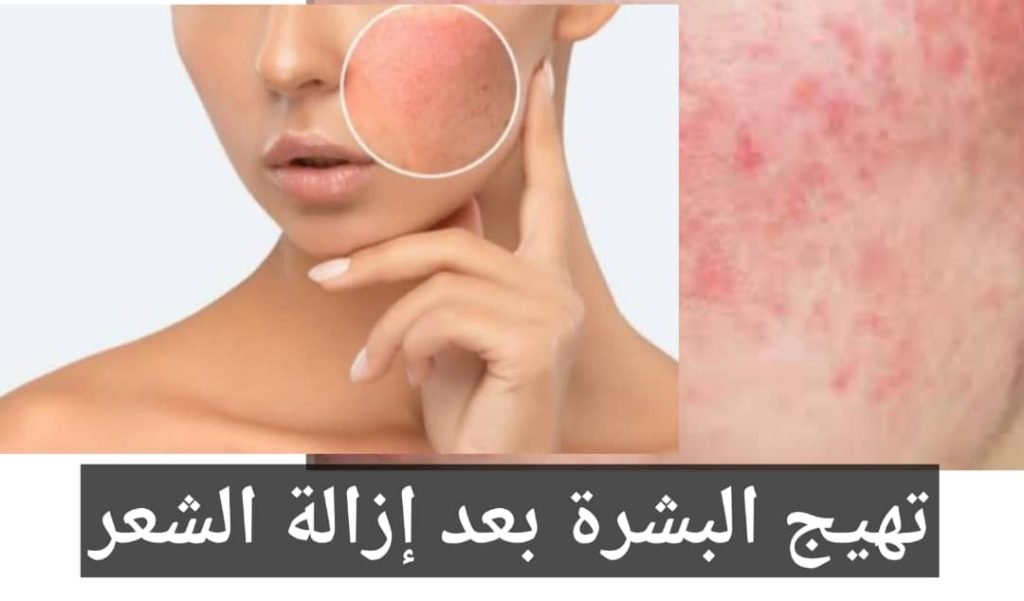 Read more about the article تهيج البشرة بعد إزالة الشعر: كيف تتجنبيه وتحافظي على جلد صحي