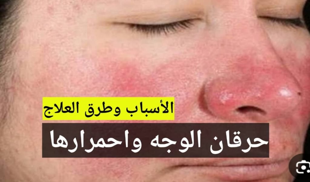 Read more about the article علاج حرقان الوجه واحمراره بسبب استخدام كريم