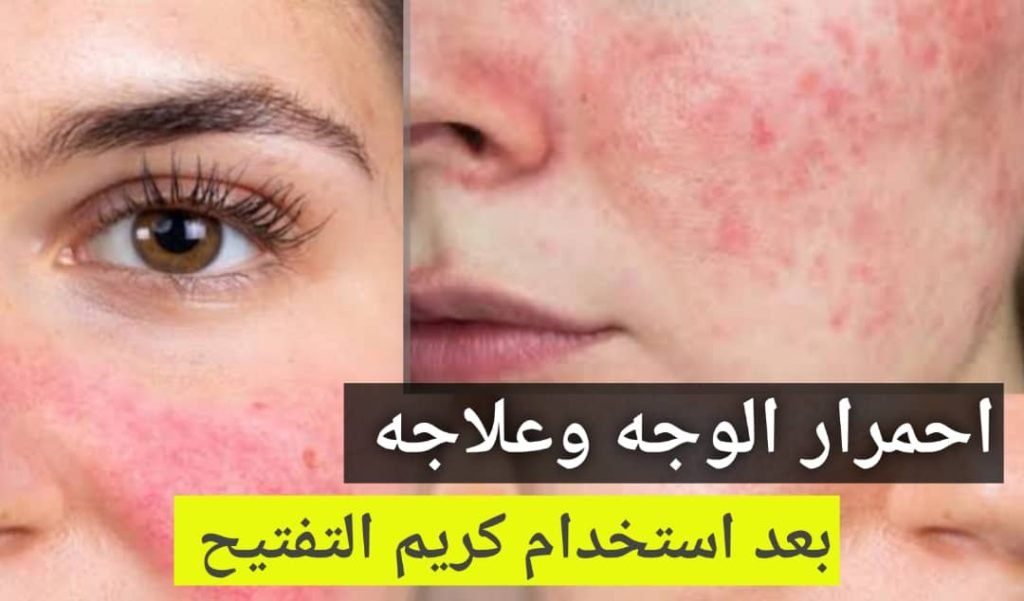 Read more about the article علاج احمرار الوجه بعد كريم التفتيح