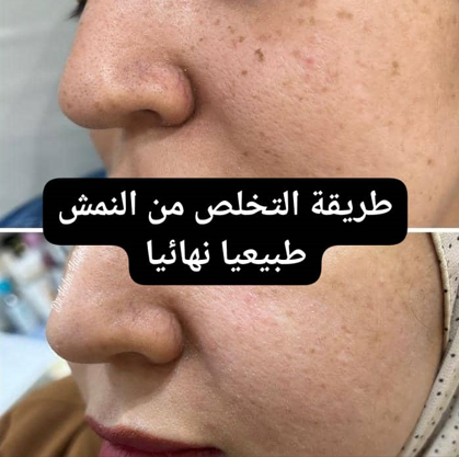 Read more about the article كيفية التخلص من النمش طبيعياً: طرق فعالة وآمنة