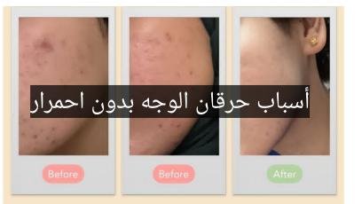 Read more about the article أسباب حرقان الوجه بدون احمرار وأهم العوامل المسببة!