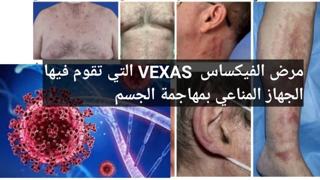 Read more about the article مرض الفيكساس VEXAS: كل ما تحتاج لمعرفته عن هذا المرض النادر