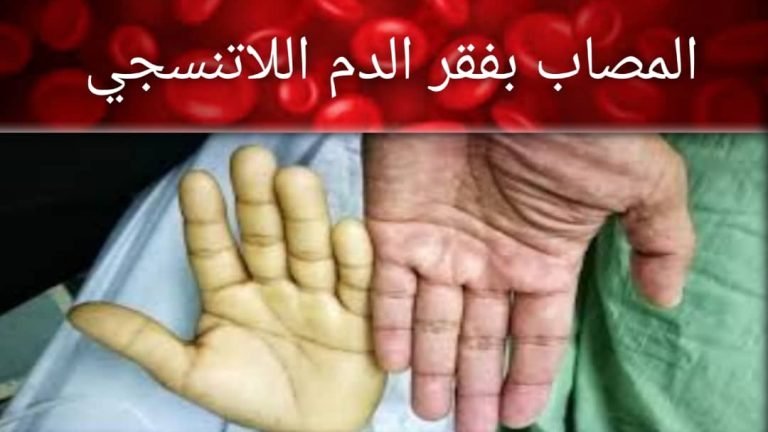 Read more about the article فقر الدم اللاتنسجي: الأسباب، الأعراض، التشخيص والعلاج