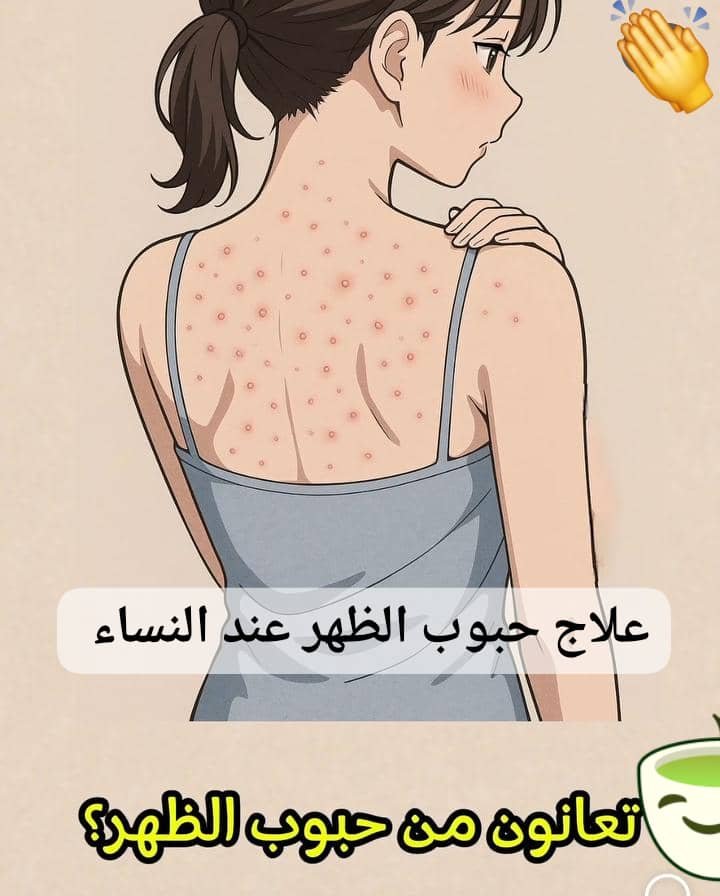 Read more about the article حبوب الظهر عند النساء: الأسباب الشائعة وطرق العلاج الفعالة