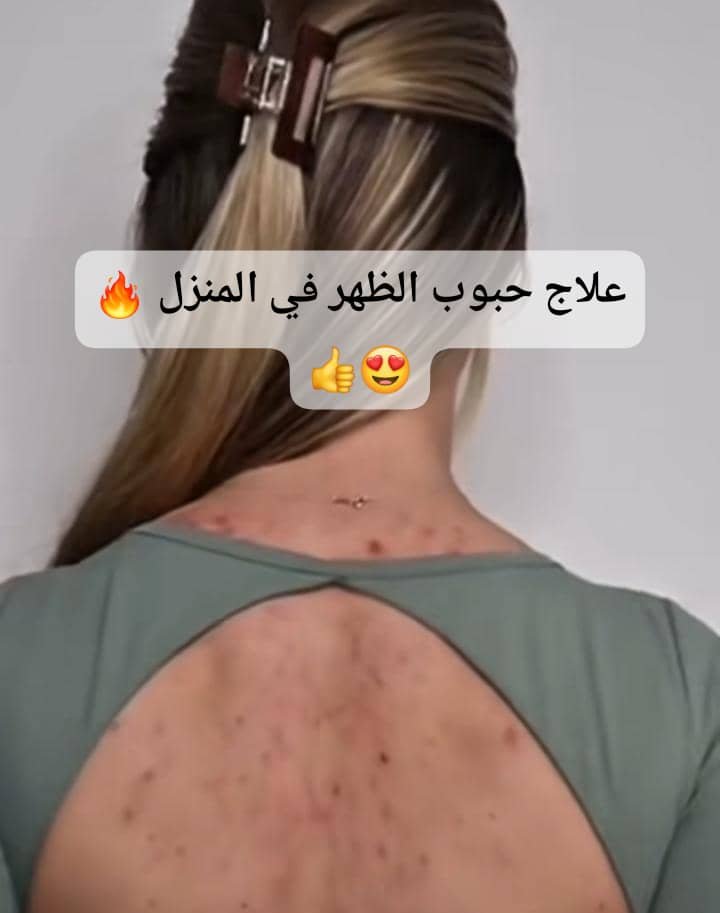 Read more about the article علاج حبوب الظهر في المنزل: طرق طبيعية وفعالة