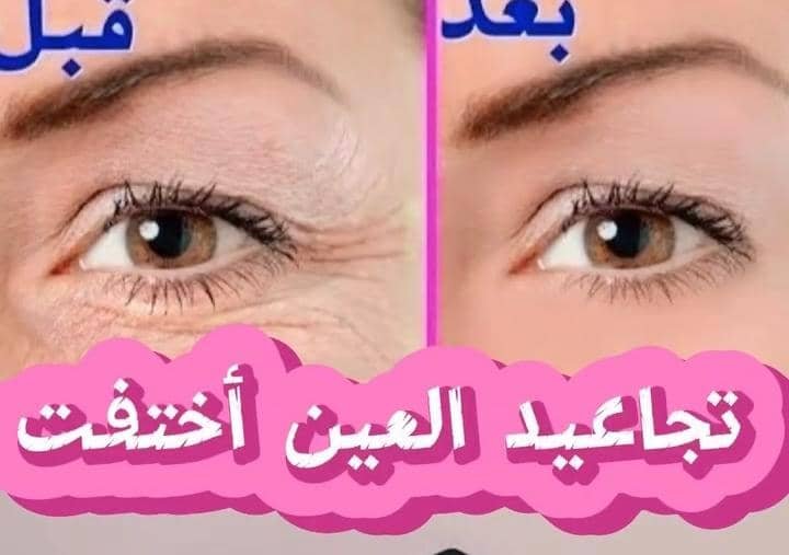 Read more about the article أفضل كريم للهالات السوداء والتجاعيد حول العين