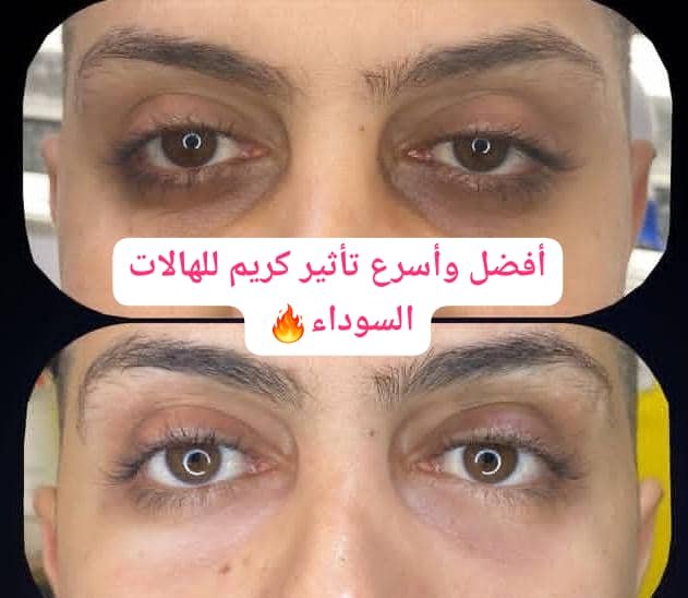 Read more about the article أفضل كريم لإزالة الهالات السوداء حول العينين