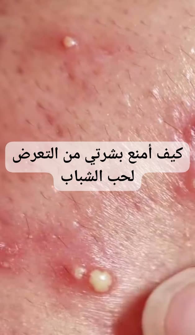 Read more about the article أفضل روتين للعناية بالبشرة المعرضة لحب الشباب