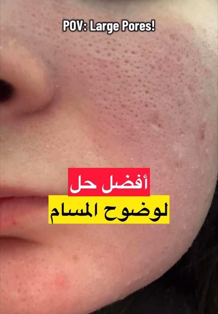 Read more about the article علاج المسام الواسعة نهائيًا في المنزل